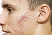 V&igrave; Sao Nam Giới Dễ Bị Mụn? C&aacute;ch Chăm S&oacute;c Da Đơn Giản, Đ&uacute;ng C&aacute;ch