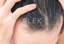Tại sao t&oacute;c nam mỏng nhanh bị mất nếp? Đ&acirc;u là nguy&ecirc;n nh&acirc;n và cách khắc phục
