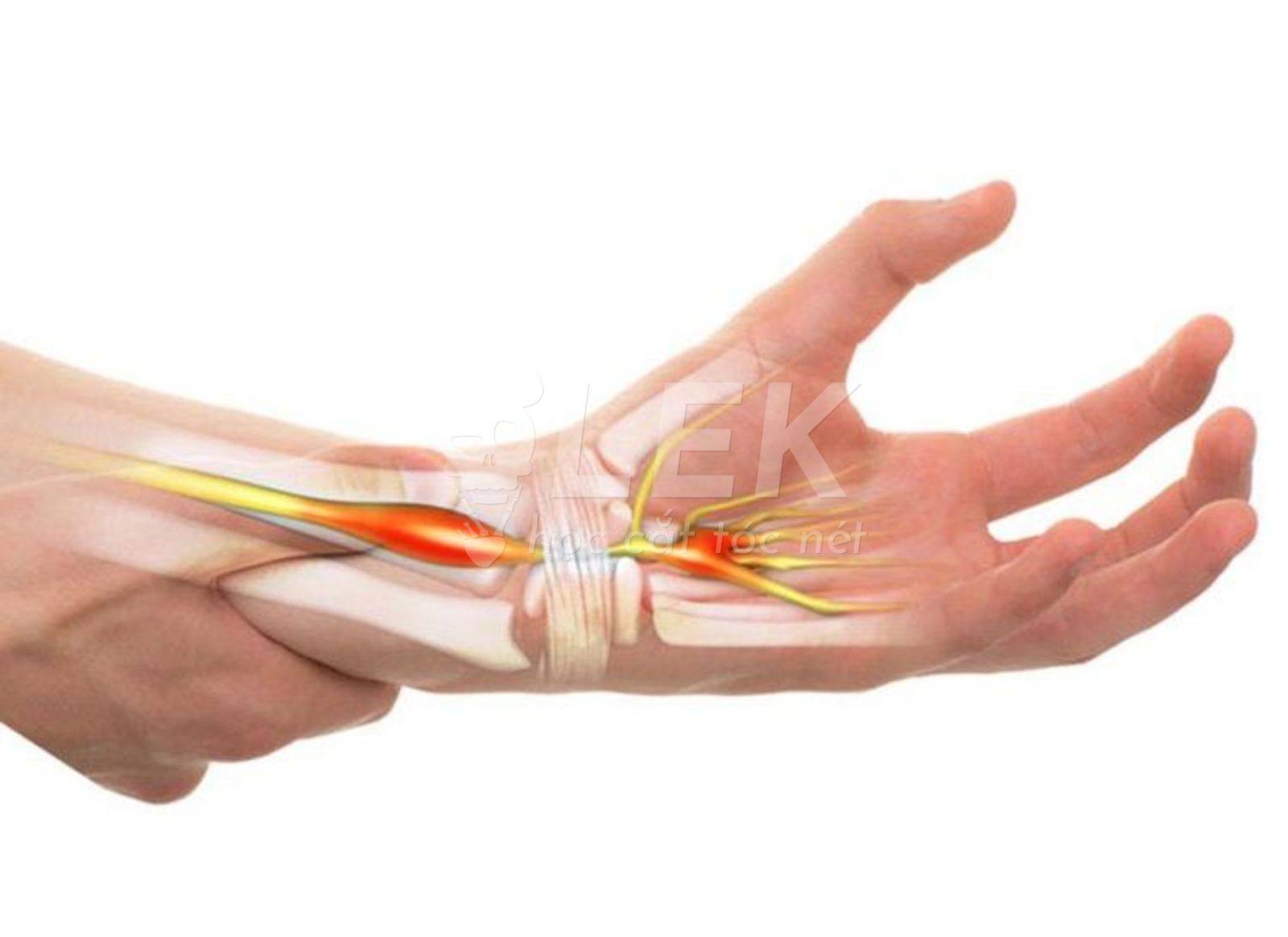 Hội Chứng Ống Cổ Tay