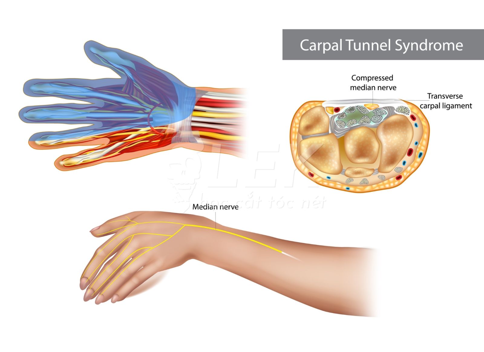 Hội Chứng Ống Cổ Tay