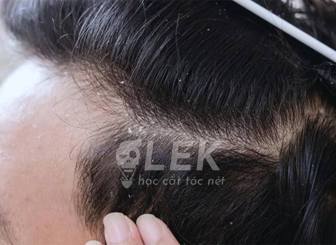 Cách trị gàu